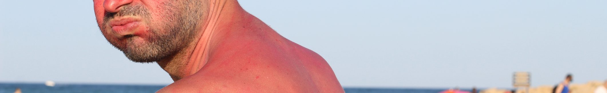 Man getting sunburned at the beach. (Photo: iStock - ajr_images)