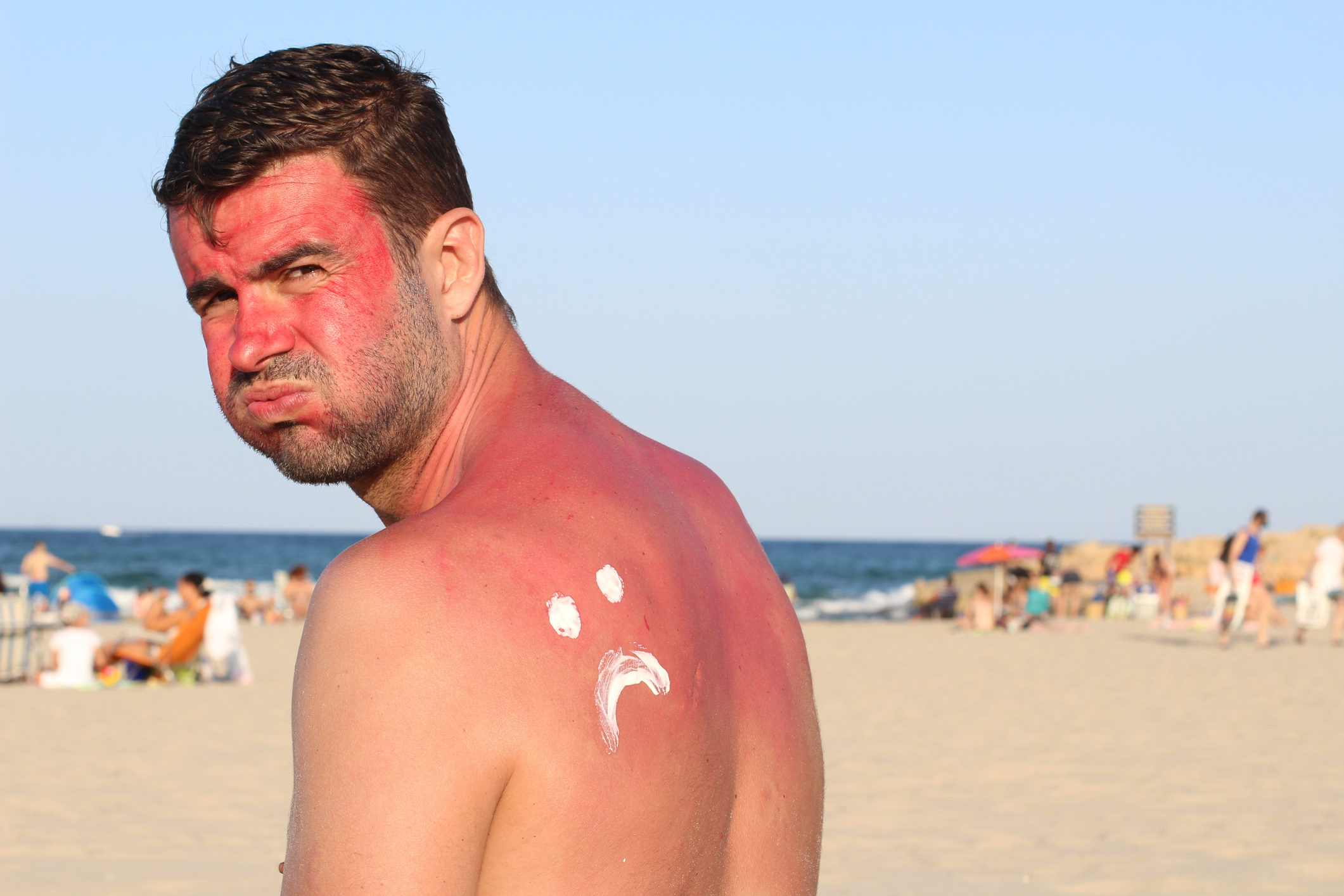 Man getting sunburned at the beach. (Photo: iStock - ajr_images)